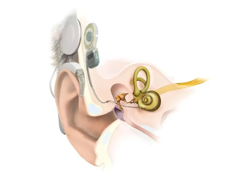 Cochlea-Implantat (CI) – ein Hörimplantat für das Innenohr